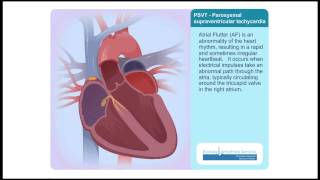 PSVT Paroxysmal Supraventricular Tachycardia Animation Video [upl. by Nyrahtak657]