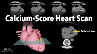 Calcium Score Heart Scan Animation [upl. by Kimble]