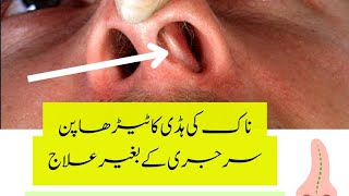 Deviated nasal septum treatment without surgery  DNS  Homeopathy [upl. by Rednazxela]