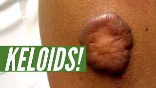 What are KELOIDS And how can you get rid of them [upl. by Aniras]