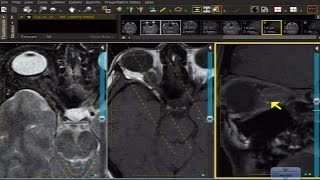 MRI Case Review How To Assess Meningioma of the Optic Nerve Sheath [upl. by Arlo141]