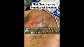 Injury to Chest causing Paradoxical Breathing [upl. by Ardith]