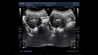 Ultrasound Video showing an Ovarian tumor [upl. by Eecyal]