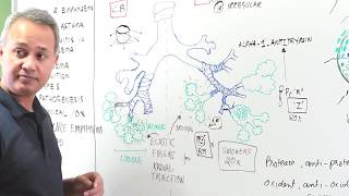 Emphysema  Clinical Presentation Diagnosis and Management [upl. by Annahs45]