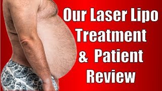 Lipo Laser ilipo Treatment amp Review From a Patient [upl. by Yeclehc]