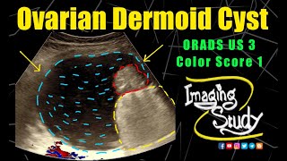 Ovarian Dermoid Cyst  Mature Cystic Teratoma  ORADS 3  Ultrasound  Case 295 [upl. by Nauqel]