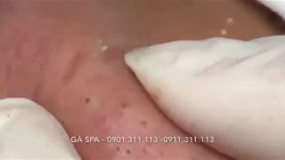 Highlight Professional blackhead popping at its best  GÀ SPA [upl. by Ruthann]