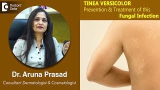 White Patches on Skin Is it TINEA VERSICOLOR  Is it Fungal  DrAruna Prasad  Doctors Circle [upl. by Watters]