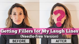 Laugh Line Fillers with Dr Andrea Herschorn Blurred Out Needles  Dermal Fillers  BEFORE amp AFTER [upl. by O'Neill]