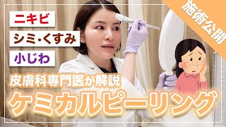 つるつる美肌に！肌質改善ケミカルピーリングの効果・注意点【皮膚科専門医】 [upl. by Eiralih]