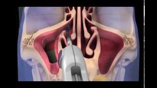 Balloon Sinuplasty Animation  Maxillary Sinuses [upl. by Kowatch]