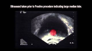 Prostiva RF Therapy Procedure Demonstration [upl. by Eidob27]