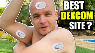 7 Best Sites for Dexcom G6 Sensor Placement [upl. by Ileek]