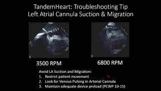 Impella Tandem Heart ECMO StepbyStep and Troubleshooting  Navin Kapur MD [upl. by Rehctelf344]