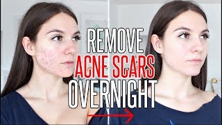 How To Get Rid Of ACNE SCARS OVERNIGHT [upl. by Okiman313]