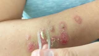 Petroleum Jelly  Tweezers vs Barnacles Psoriasis [upl. by Asia951]