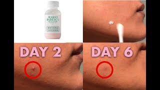 TESTING MARIO BADESCU DRYING LOTION How Many days to get rid of a zit [upl. by Thrasher]