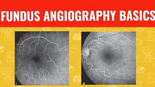 FFA course  FUNDUS FLUORESCEIN ANGIOGRAPHY [upl. by Cissej]