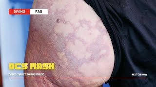 Decompression Sickness Rash [upl. by Kamaria]