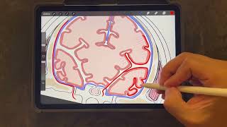 Hematoma subdural [upl. by Linetta757]