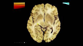 Neurology Exam Cranial nerves I and II [upl. by Ferdinana]