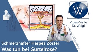 Herpes Zoster Gürtelrose durch WindpockenViren 😬 Schmerzen amp Ausschlag  Entstehung amp Therapie [upl. by Fital]