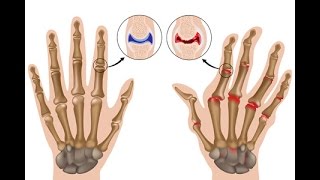 Rheumatoid Arthritis [upl. by Adnilra]