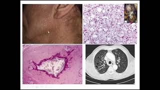 Renal Tumors Case 5 [upl. by Elleinnad]