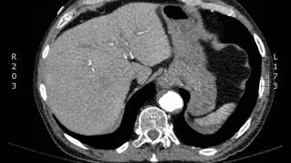 Life After Aortic Valve Replacement [upl. by Oivat]