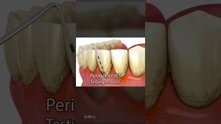 Periodontitis and Laser Hardening Surgery 3D Animation [upl. by Ithaman]