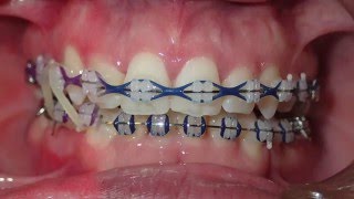 Orthodontic Transformation from Start to Finish [upl. by Demaria]