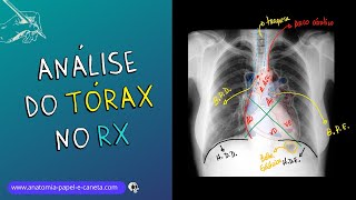 Aprenda a analisar o exame de TÓRAX no RX [upl. by Alake]