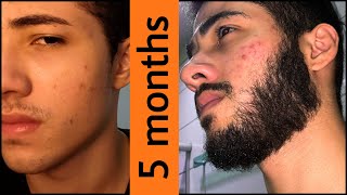 Minoxidil Beard Journey 5 MONTHS TRANSFORMATION [upl. by Ititrefen606]