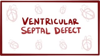 Ventricular septal defect VSD  repair causes symptoms amp pathology [upl. by Aihpledalihp]