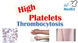 What Causes High Platelets Thrombocytosis  Approach to Causes Symptoms Treatment [upl. by Ruhnke]