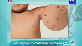 4 Best Wart Removal Remedies – Dr Berg on Wart Treatment at Home [upl. by Wooldridge]