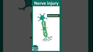 Types of nerve injury  neuropraxia  axonotmesis  neurotmesis  Wallerian degeneration  USMLE [upl. by Jaal223]