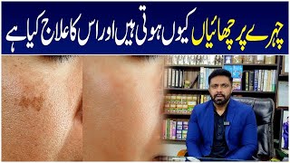 Chaiyon ka ilaj malasma treatment [upl. by Defant]