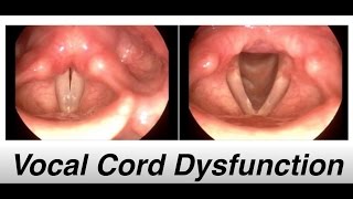 vocal cord dysfunction  Patient Education Video [upl. by Now13]