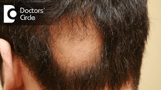 Treatments for alopecia areata  Dr Shuba Dharmana [upl. by Ayal]