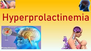 Hyperprolactinemia  Causes Symptoms Clinical Features Diagnosis Investigations and Management [upl. by Ping]