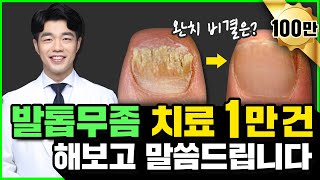 발톱무좀 치료 1만번 해본 피부과전문의가 말합니다 발톱무좀약 발톱무좀레이저 발톱무좀제거 [upl. by Lahey]