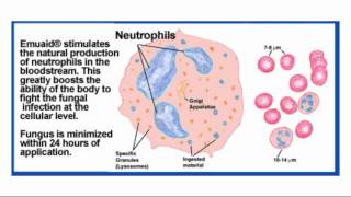 Balanitis Treatment [upl. by Malachi]