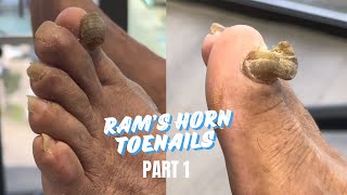 2 RAM’S HORN TOENAILS  PEDICURE PART 1 [upl. by Tavey501]