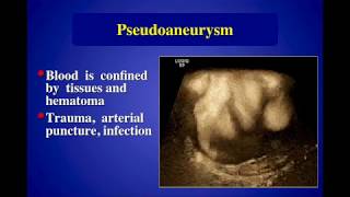 Endovascular Aortic Aneurysm Repair [upl. by Leahcimnhoj]