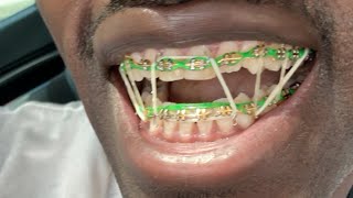 GOLD BRACES Fix Your teeth the RIGHT way [upl. by Lashonda901]