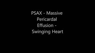 Massive Pericardial Effusion  Swinging Heart  Transthoracic Echocardiogram TTE [upl. by Tigirb]