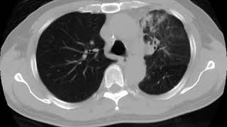 Lymphangitis carcinomatosis Ahuja AT et al 2017 Book Essential Radiology [upl. by Leonor]