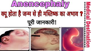 Anencephaly  Causes  Symptoms  Treatment  prevention in hindi  medical Destination [upl. by Nnylaehs]