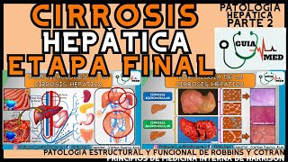 CIRROSIS HEPÁTICA ETAPA FINAL  GuiaMed [upl. by Abla207]